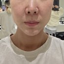 이수역 피부과, 얼굴 작아지는 온다 리프팅 후기