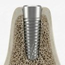 블랑쉬치과의원 | 임플란트 수술 후기모음 및 비용