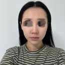 로그성형외과의원 | 윤곽라인 이중턱 얼굴살 정리 사각턱보톡스 소개팅 주사 내돈내산 2주 후기