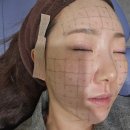 [압구정역피부과] 써마지 600샷, 2주간 후기, 가격, 탄력 효과