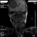 C-spine MRI 촬영중 스카웃에서 얻어걸린(?) 영상... 이미지