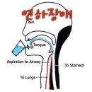 연하 곤란증(음식물 삼킴 장애)의 원인과 치유법 이미지