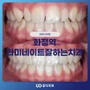 유디화정치과의원 | 화정역라미네이트잘하는치과 앞니가 벌어져있어 신경 쓰여요