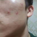 하나로한의원 | 여드름흉터한의원 다니며 자국 없앤 찐 후기