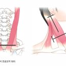 선천성 사경(Muscular torticollis) 이미지
