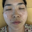 인천서구에스테틱 스며들다 에스테틱에서 잡티제거 후기!!