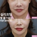먼지나요디자인 | 실리프팅 몇 줄이 적당할까? 성형외과 전문의가 말하는 '개수보다 중요한 것'