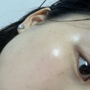 청담동 피부과 BB레이저 + 듀얼토닝 후기