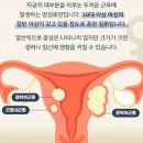 여성 하혈원인 부정출혈 원인 증상 여자 스트레스 생리 자궁근종 통증 이미지
