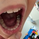 기린치과의원 | 48개월 아이 진정치료+은니+떼우기치료 내포아이랑소아치과 진료 후기