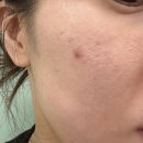 새서울한의원 | 명동여드름흉터 한의원 서브시전 후기