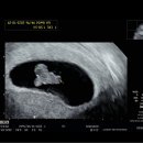 임밍아웃 시기 임신 초기 증상 장꾸맘 12주 초음파 입덧 후기