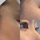 수한의원 | 대전 편평사마귀 성지 하늘체한의원 무제한 제거 후기 | 내돈내산 | 전후사진