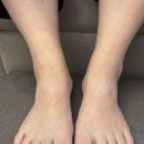 완산-108 | 완산동 내성무좀발톱 개선 후기 많은 이유