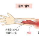 팔꿈치 통증 증상 테니스엘보 골프엘보 이미지