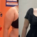 지방 | 팔뚝&amp;복부 지방흡입 후기 | 부작용,흉터 관리 + 마운자로 다이어트 비교