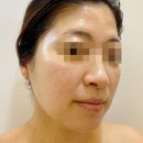 고은 에스테틱 - 군포시 | 용인 역북 피부관리 추천, 새로고은 에스테틱 엑소좀 뉴콜드 플라즈마 후기