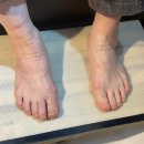 평택 ‘네일 수아비’ | 내성발톱•스케일링 문제성 발 케어 잘하는곳