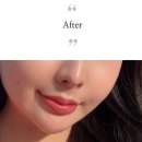 이서의원 | 구월동 피부의원, 입술필러 잘하는곳 후기, (입술필러 녹이고 재시술후기)