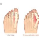 발바닥 무지외반증 통풍 지간신경종 족저근막염 아킬레스건염 증상 이미지