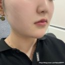 민트커뮤니케이션 | 압토스실리프팅 가격 통증 붓기 유지기간 효과 수면마취 후기