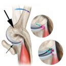 Rotator Cuff Syndrome as a Cause of Neck Pain 이미지