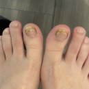 원보당약국 | 발톱무좀밴드 패치 후기
