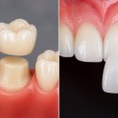 벤처세라믹치과기공소 | 치과위생사가 말하는 라미네이트, 솔직 후기 하면 후회할까?