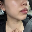 케이피부과의원 | [결혼준비 일상] 부산 서면 피부과 티타늄 포트라콰트로 20KJ 후기