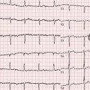 진성ESC | 가성 페이스메이커 증후군(Pseudo-pacemaker syndrome)