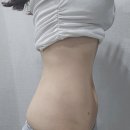 우주약국 | 마른비만이 지방흡입 대신 러브핸들 지방추출주사 받은 후기