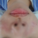 오상명가 | 포항피부관리 잘하는 스킨힐링스 문덕점 pha문제성여드름재생술관리 받았어요