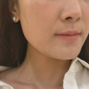 대신건재 | 팔자주름 삭제 쥬브젠 후기, 필러·지방이식 대신 선택한 이유! 전후 변화·멍·통증 내돈내산