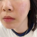 할로피플 | 홍대피부과추천 엑셀브이레이저 홍당무인의 홍조스트레스 개선