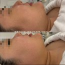 대구수성구턱밑살,이중턱리프팅/얼굴살이많은사람 리프팅은?