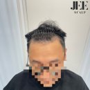 지스칼프