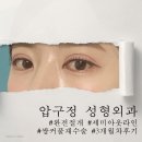 쌀알말이 | 2024년 완전절개 세미아웃 쌍커풀 재수술 3개월차 마지막 후기