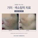 지앤영 | 강남역피부과 피코토닝 레이저로 깨끗이 기미 잡티 제거한 후기✨