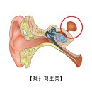 청신경초종[Vestibular schwannoma]귀코목질환, 뇌신경정신질환 이미지
