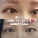 [내돈내산] 아이라인 반영구 및 눈썹 문신제거 2회차 후기, 일주일 기록, 병원 추천