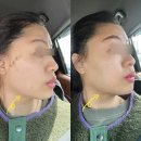 고고성형외과의원 | 강남역 신논현역 피부과 얼굴실리프팅 일주일후기 (붓기,통증,마취,부작용,유지기간)