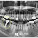 뿌리내린치과의원 네이버블로그