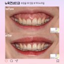 거미스마일 원인 치료 방법