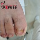 레푸스 무좀 관리 후기