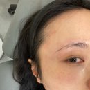 정발산약국 | 일산피부과 6년만에 재발한 편평사마귀제거 후기 ✨ 레이저로 전체제거 완료(통증, 붓기, 회복기간)