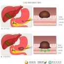 비만으로 합병증 동반하면 건강보험적용 가능 여부 이미지