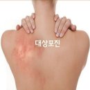 대상포진 이미지
