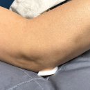 간호사 잉끼추천2, 피부에 자극 없는 실리콘 폼 드레싱, 욕창 드레싱 친우엠테크 하이솝 스탠다드