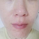 역촌동 피부관리 &#39;이지뷰티랩&#39; 플라즈마 여드름 관리 후기