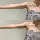 하단팔뚝슬리밍 바디젯 관리받고온후기 달리핀에스테틱 하단점